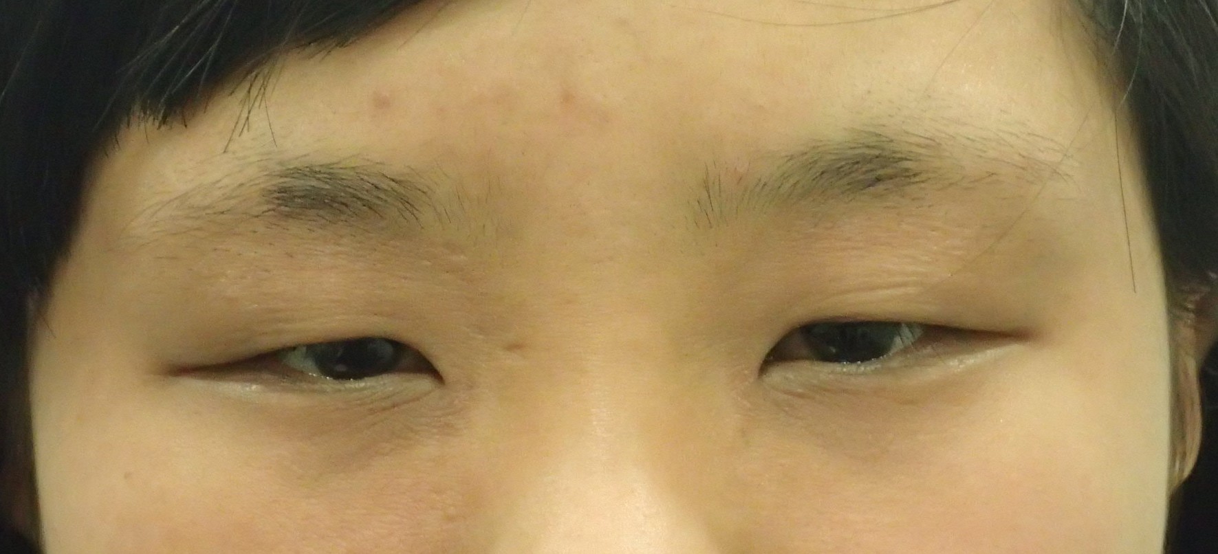 一重瞼に伴う眼瞼下垂症と横径が小さいのは眼裂狭小症。この様に治すと魅せられます。 - ドクター森川ブログ