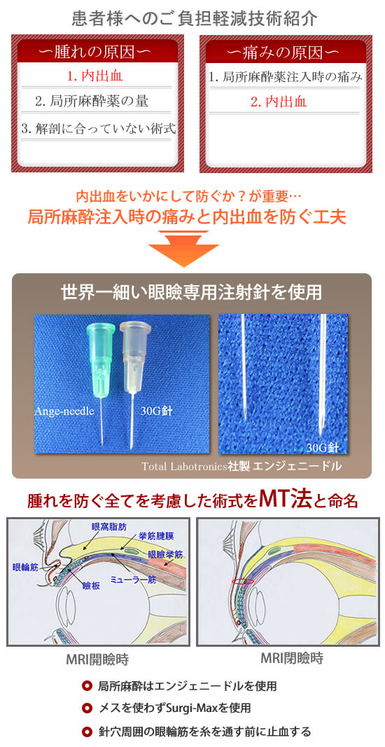 美容外科・二重まぶた 埋没法・MT法/東京皮膚科・形成外科