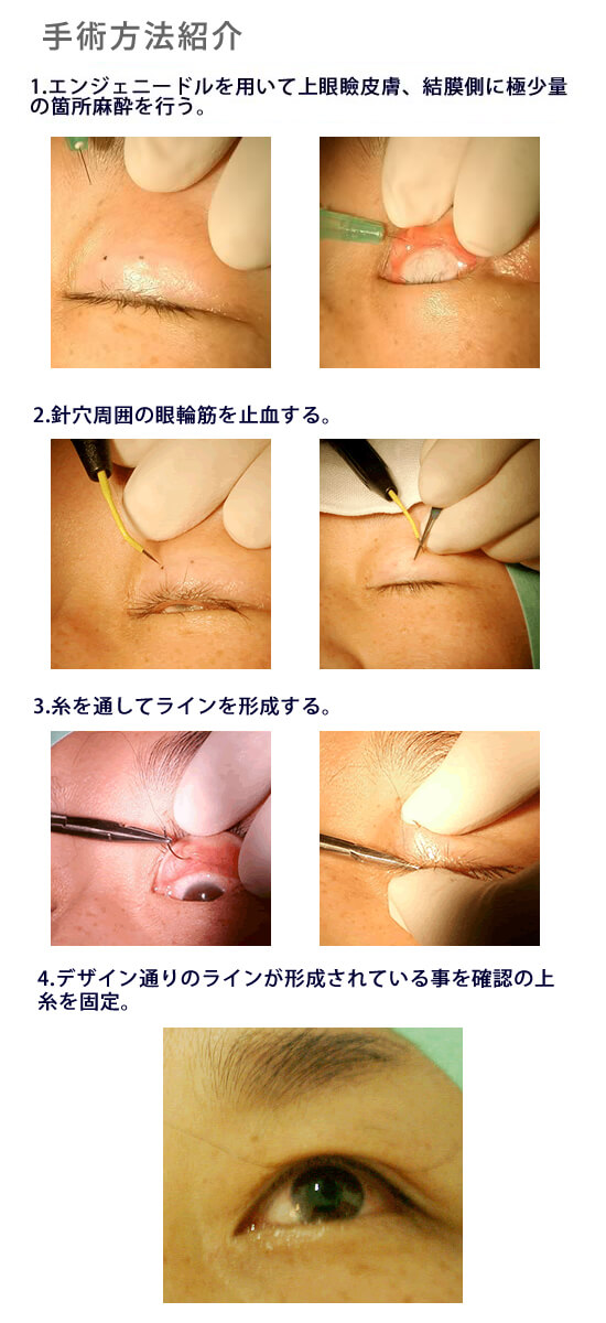 美容外科・二重まぶた 埋没法・MT法/東京皮膚科・形成外科