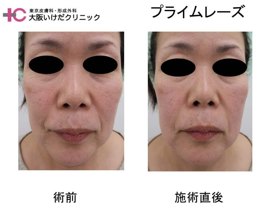 プライムレーズ - 大阪いけだクリニック 黒崎泰史ドクターブログ