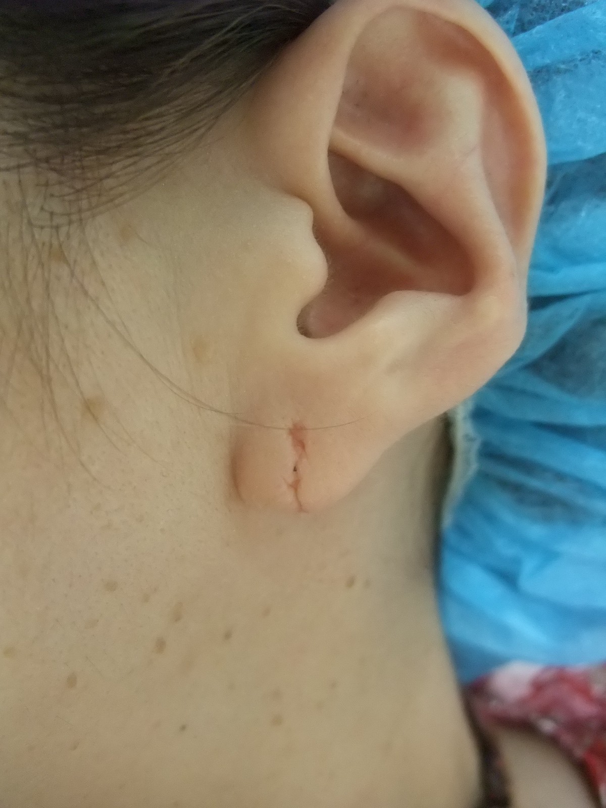 ピアスで耳たぶが割れた人を治す 後天性耳垂裂に対する手術法 ドクター森川ブログ