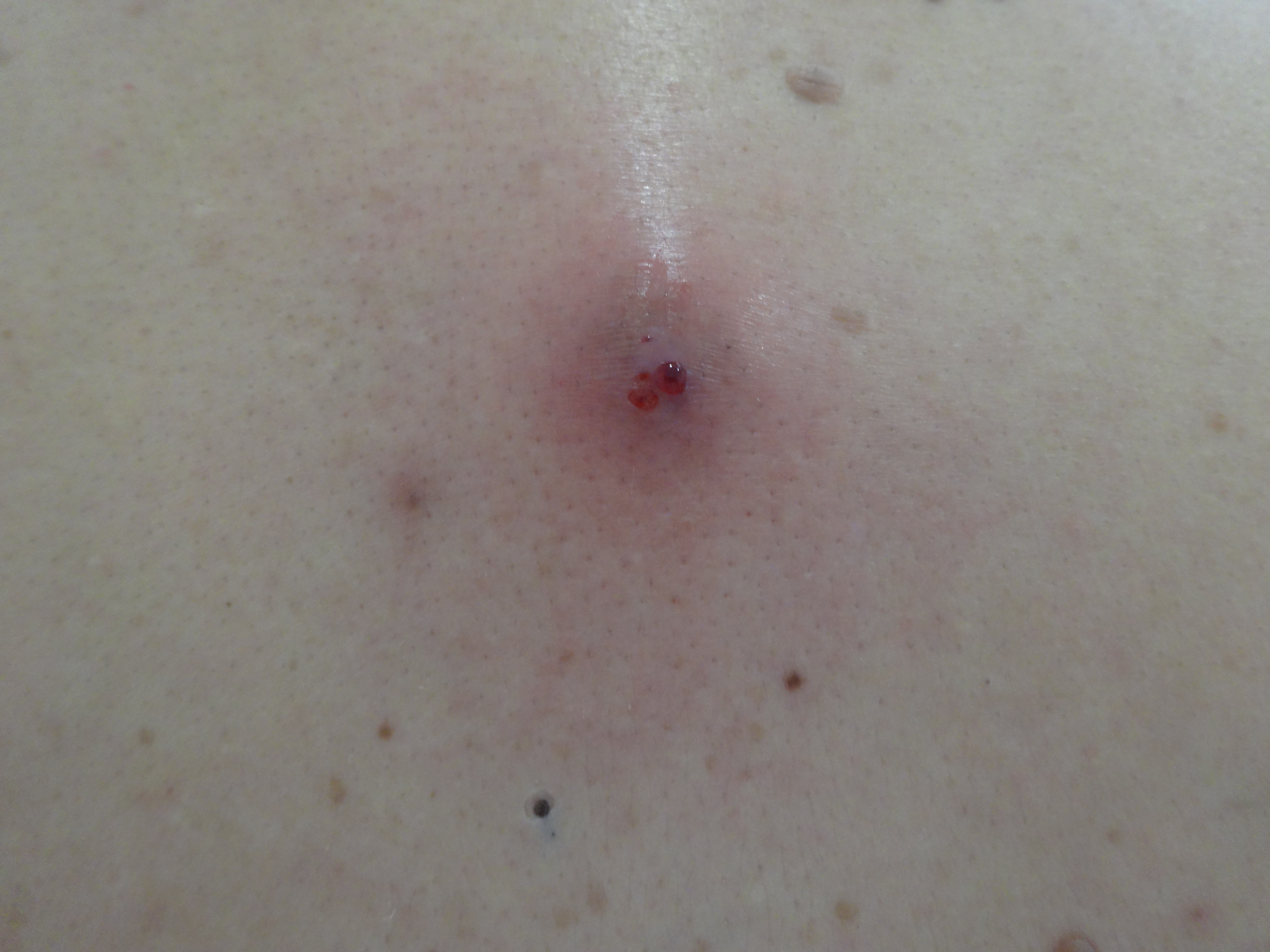 粉瘤 類表皮嚢腫 アテローム Epidermal Cystの経過 ドクター森川ブログ