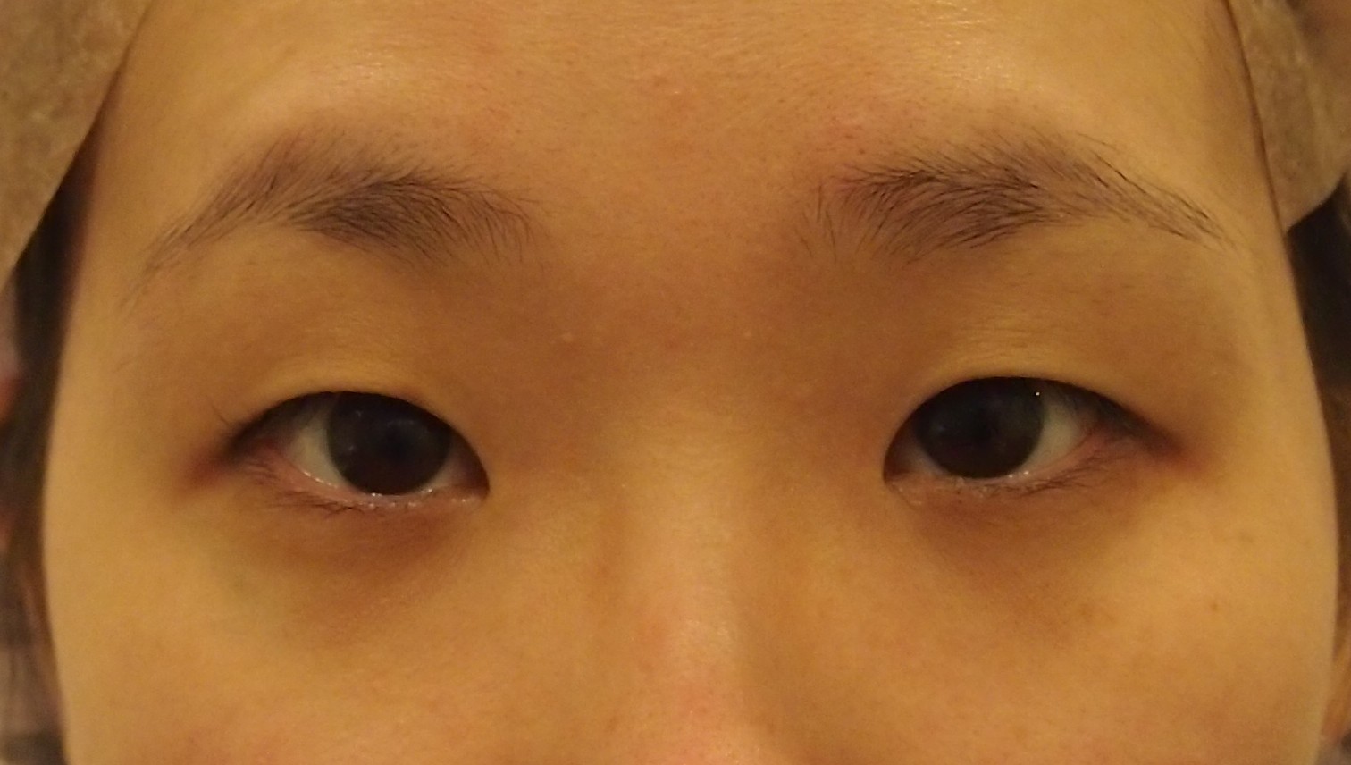 子供っぽい目元を大人っぽい眼に 黒目整形 眼瞼下垂手術埋没法と 目頭切開z 形成術法 蒙古襞の拘縮解除術 3か月で完成としましょう ドクター森川ブログ