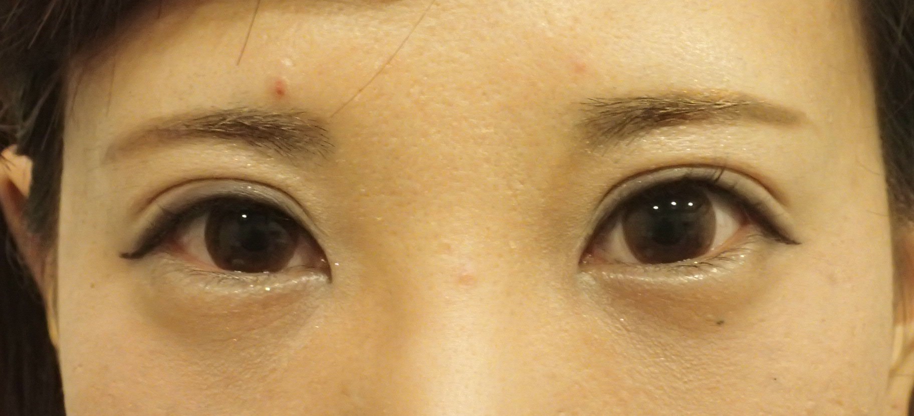 眼瞼下垂症と横径が小さいのは眼裂狭小症といいます。経過が長いでしょう。そこで最近の症例と比較してみます。 - ドクター森川ブログ