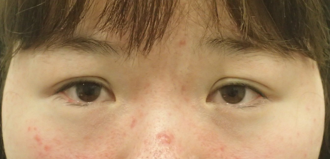 目の横径が小さいけれど 開瞼は見事にできました 術後3か月で完成 ドクター森川ブログ