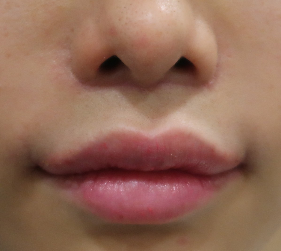 長い白唇は切除術が適切です 口角は上手に挙がりました ドクター森川ブログ