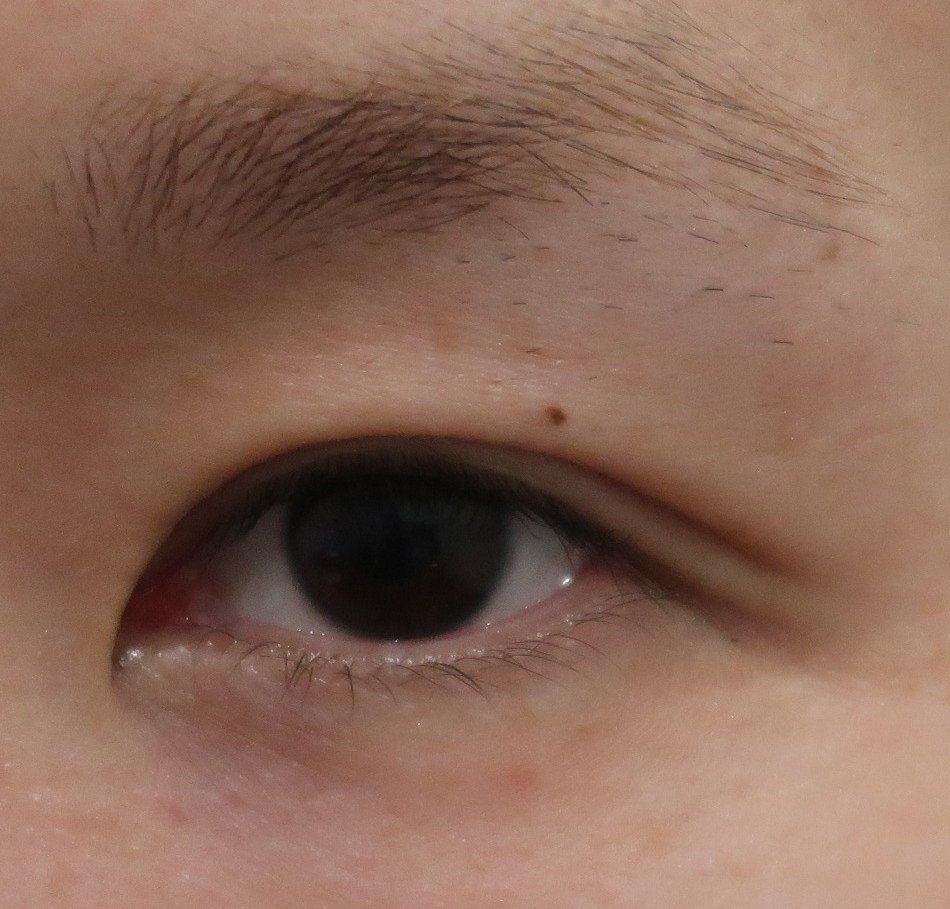 たまにはブログに切らない眼瞼下垂手術と目頭切開の手術と図を載せましょう 蒙古襞の拘縮解除の為のｚ 形成法は自然 ドクター森川ブログ