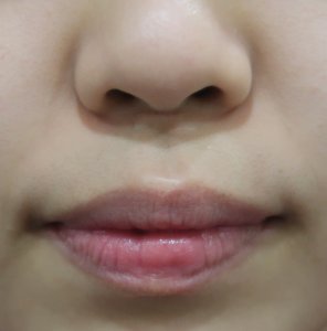 目的のある人中部白唇短縮術もあり得ます ドクター森川ブログ