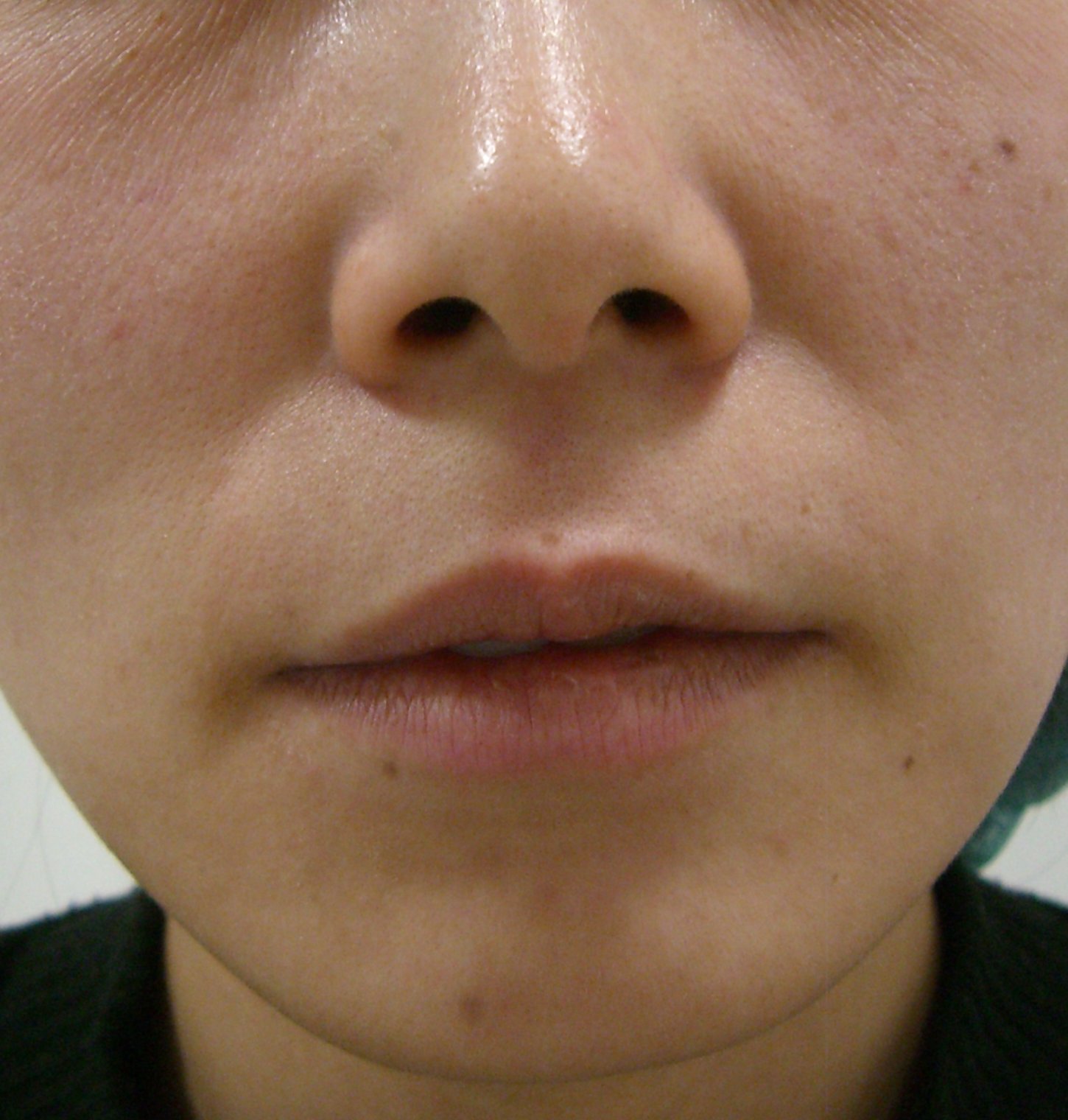 モッコリした白唇はやはり短縮の適応です 下がった口角に対する挙上術から １ヶ月後に人中部白唇短縮術も ドクター森川ブログ