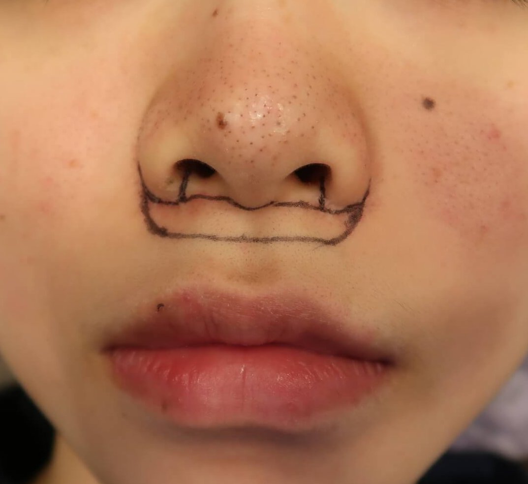 人中部白唇(鼻の下)短縮術は定番。鼻翼縮小術皮弁法の併施もお奨め。口角挙上術は後回しが助かります。 ドクター森川ブログ