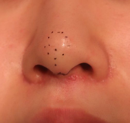 鼻尖形成は軟骨移植で自然に存在する良好な形態 ドクター森川ブログ