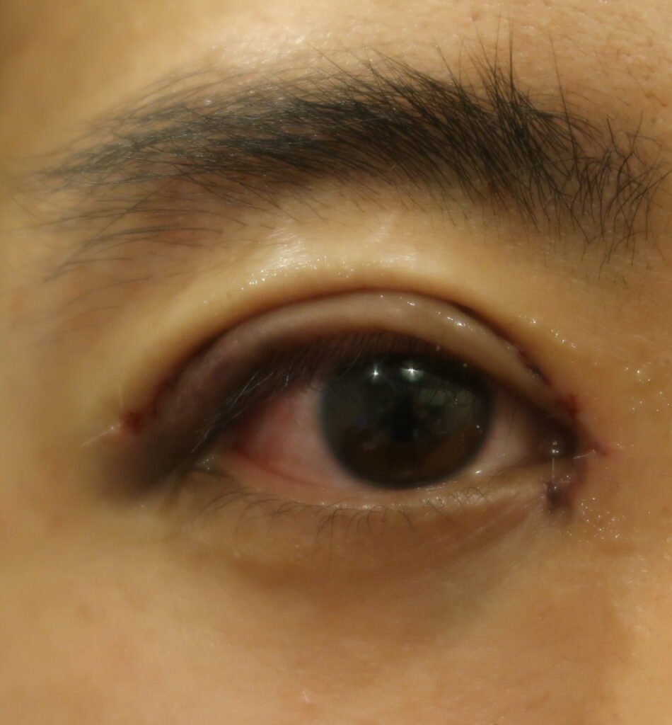 一重瞼という先天性前葉性眼瞼下垂症患者さんは、遺伝子が同座ですから、蒙古襞の拘縮を伴います。 - ドクター森川ブログ