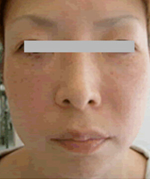 美容外科・二重まぶた 埋没法・NSLT法2点/東京皮膚科・形成外科