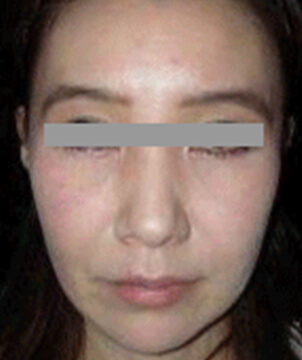 美容外科・二重まぶた 埋没法・NSLT法2点/東京皮膚科・形成外科